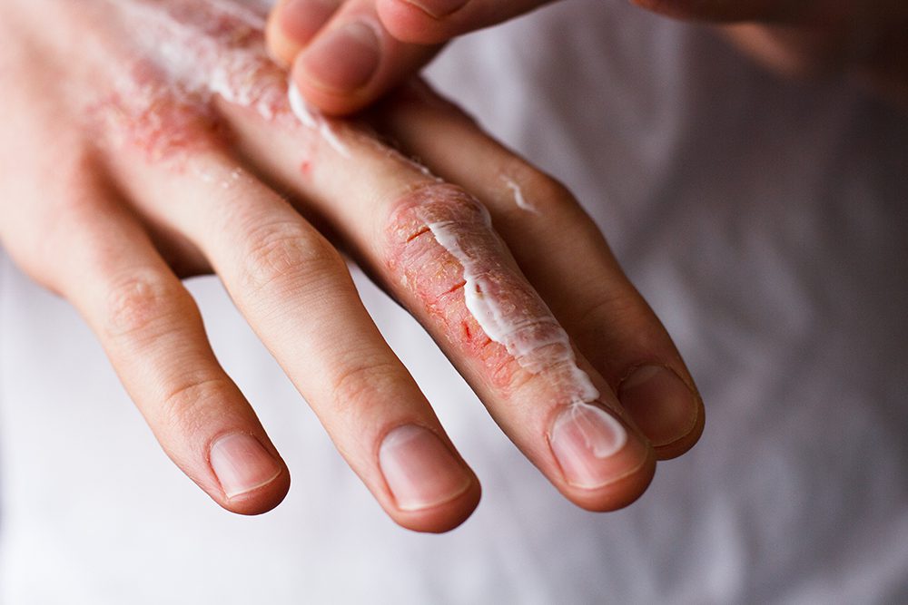 Psoriasis – More Than Just A Skin Disease!