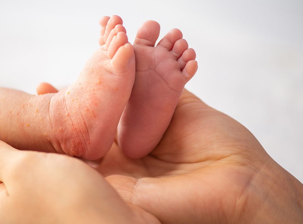 baby-eczema