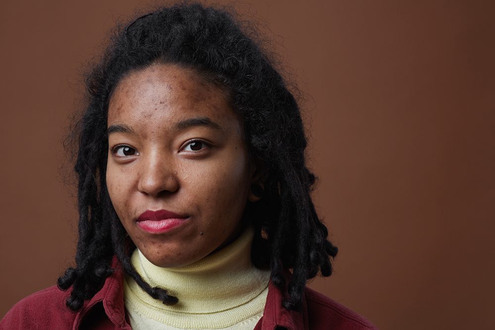 acne on skin of colour