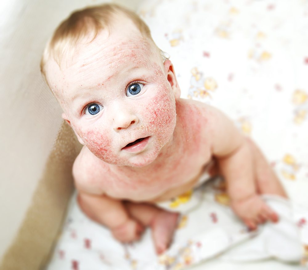 eczema