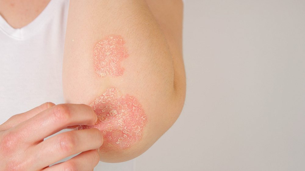 10 Truths About Psoriasis