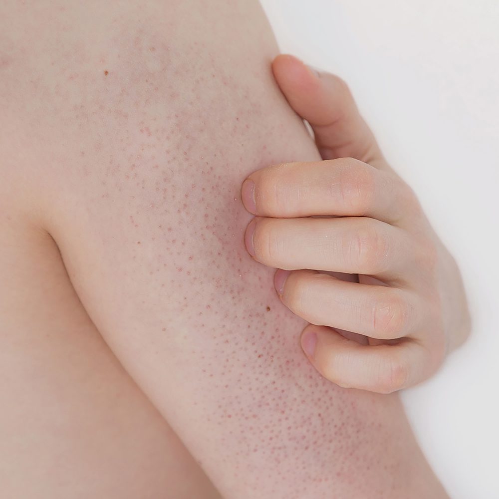 Keratosis