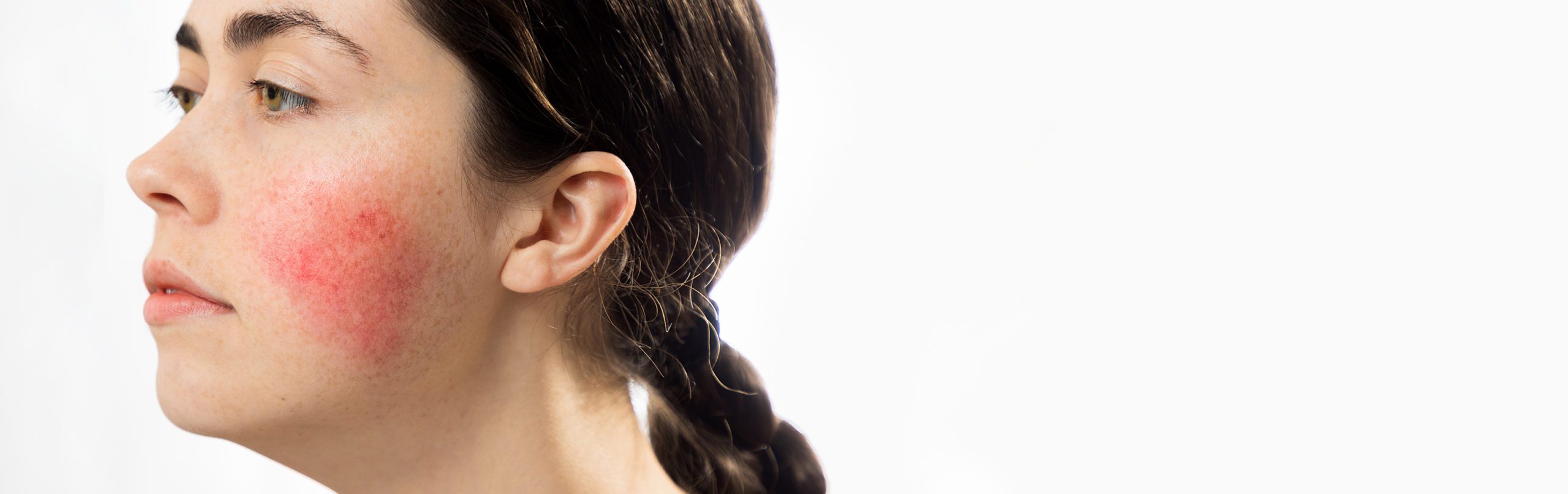 Rosacea, swimming and exercise